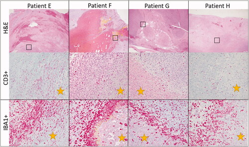 Figure 5. Representative immunohistochemistry images from patients treated in our HIFU study. The top row illustrates CD3 immunohistochemistry for dogs diagnosed with soft tissue sarcomas that were treated with HIFU while the bottom row illustrates IBA-1 immunohistochemistry for the same patients. Positive cells are stained red. CD3+ cells are present throughout the untreated tumor cells as well as at the interface and within the treated section. There is not a definitive or consistence difference in the number of CD3+ cells at the treatment interface. IBA1+ cells, however, consistently were high in numbers at the treatment interface though were also present within untreated and treated tumor as well. Treated tumor is marked with a yellow star. Images taken at 20x, DAB counterstain.