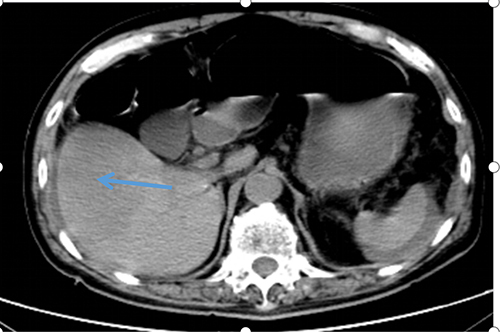 Figure 4 Plain scan shows multiple irregular low-density shadows of different sizes in the liver.The larger ones are located under the right lobe capsule with clear boundaries. The blue arrow points to the liver infarction lesion observed on CT plain scan.