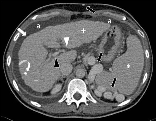 Figure 16 Axial post-contrast CT image in a patient with cirrhosis.