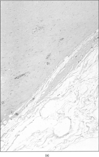 Figure 3 Sharp margins of the lesion (a) and deeply collagenized stroma with spindle to stellate cells (b).