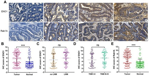 Figure 1 Expression of ENO1/Rab1A in CRC tissues. (A) Immunohistochemical (IHC) staining of ENO1/Rab1A in 135 pairs of primary human CRC and adjacent normal tissues (200×). The expression of ENO1 protein was negative (a), weak (b), positive (c), or strongly positive (d). The expression of Rab1A protein was negative (e), weak (f), positive (g), or strongly positive (h). (B) Staining scores of ENO1 in CRC tissues and adjacent normal tissues. (C) Staining scores of ENO1 in lymph node invasion-positive and negative patients. (D) Staining scores of ENO1 in TNM I-II and TNM III-IV stage tissues. (E) Staining scores of Rab1A in CRC tissues and adjacent normal tissues. ***P < 0.001. ns: not significant. Scale bar = 100 μm.