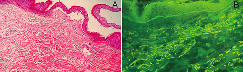 Figure 2 Histopathological and direct immunofluorescence examinations from vesicular lesion. Subepidermal blistering with a small infiltration of lymphocytes and eosinophils in the superficial dermis (A) (H&E, 100×). Linear IgG and C3 deposits at the basement membrane zone (B).