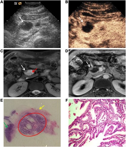 Figure 3 A mucinous cystadenocarcinoma diagnosed via pathology in a 48-year-old woman without symptoms. (A) A US image shows a cystic lesion with a hypoechoic attachment (white arrow) 2.5 cm in diameter in the pancreatic head. (B) A CEUS image clearly displays the round margin and a nodule in the cyst (white arrow) with enhancement. (C) T2-weighted MRI confirms presence of lesion and shows a nodule (white arrow) and thin intralesional septa (red arrow). (D) Enhanced MRI reveals the nodule (white arrow). (E) Photograph of pathologic specimen through HE staining reveals a nodule (red circle), cyst wall (yellow arrow), and pancreas parenchyma (green arrow). (F) Malignant tumor cells as shown under high power microscope.