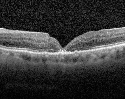 Figure 4 Postoperative optical coherence tomography showing successful closure of macular hole following trauma.