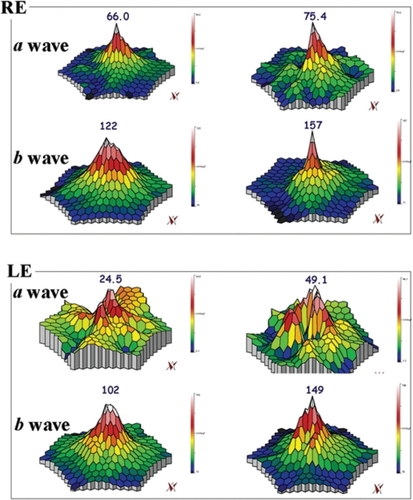 Figure 1 mfERG showing the peaks of a and b waves for case three. In the RE, the peak of the a wave increased from 66 nV/deg2 (top left panel) to 75.4 nV/deg2 (top right panel), and, in the LE, from 24.5 nV/deg2 (bottom left panel) to 49.1 nV/deg2 (bottom right panel), after six months. The peak of the b wave improved from 122 nV/deg2 (top left panel) to 157 nV/deg2 (top right panel) RE, and from 102 nV/deg2 (bottom left panel) to 149 nV/deg2 (bottom right panel) LE, after six months.