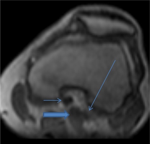 Figure 3 Reconstructed flash 3D post-contrast T1-weighted magnetic resonance image of the left knee in the transverse plane demonstrates the medial head of the gastrocnemius muscle (thick arrow) between the occluded popliteal artery (short thin arrow) and the popliteal vein (long thin arrow).