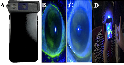 Figure 1 SEC as smartphone attachment device (A). TBUT examination under slit lamp (B) using SEC (C). A non-ophthalmologist filmed TBUT test using SEC (D).