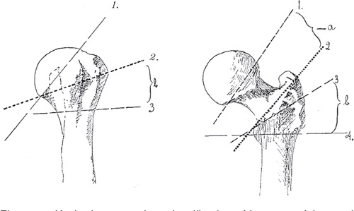 Figure 17. Kocher’s approach to classification of fractures of the proximal humerus and the proximal femur. Reprinted from Kocher (Citation1896) 108.