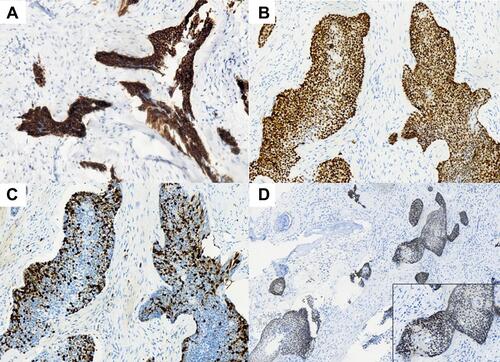 Figure 3 Immunohistochemistry staining of tumor cells that were positive for CK (A ×200), p40 (B ×200) and NUT (D ×40; inset ×400). Ki-67 index of tumor cells was >60% (C ×200).