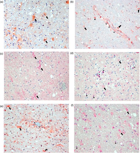 Figure 4. Immunohistology for molecularly detectable biomarkers in the brain of patients with BoDV-1 encephalitis. Panel A: Immunoperoxidase staining for glial fibrillary acidic protein (GFAP, 1:100; Zytomed Systems, Bargteheide, Germany; with citrate pretreatment), demonstrating activated, bizarre and enlarged astrocytes (arrows). Panel B: Immunoperoxidase staining for interferon-γ (IFNγ; 1:300; Abcam, Cambridge, UK; with citrate pretreatment), showing positivity in endothelial cells (asterisks), and most likely in microglia (arrowheads) and astrocytes (arrows) perivascularly. Panel C: Immunophosphatase staining for interleukin 6 (IL-6; Biosource-Thermo Fisher Scientific; with EDTA pretreatment), demonstrating ramified activated microglia (arrows). Panel D: Immunophosphatase staining for fibroblast growth factor-1 (FGF-1; LifeSpan BioSciences, Huissen, the Netherlands; with EDTA pretreatment), showing positivity in perivascular brain cells (asterisks), oligodendrocytes (arrowheads) and weakly in enlarged astrocytes (arrows). Panel E: Immunoperoxidase staining for transforming growth factor-β (TGF-β; DCS-diagnostics; with citrate pretreatment), demonstrating positivity in endothelial cells (asterisks) and mainly in activated astrocytes (arrows). Panel F: Immunophosphatase staining for tissue inhibitor of metalloproteinase 1 (TIMP1; Biosource-Thermo Fisher Scientific; with citrate pretreatment), showing positivity in activated and enlarged astrocytes (arrows) and in oligodendrocytes (arrowheads). All panels show basal ganglia sections with an original magnification of ×200. Symbols show a few examples of cell types only.