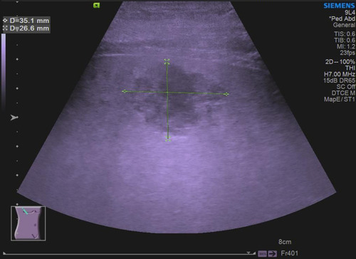 Figure 2 Abdominal ultrasound showed a right lobe liver abscess (mixed echoes, with a size of 3.5cm×2.7 cm).