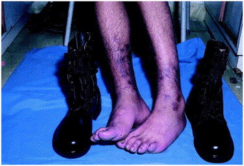 Figure 9. Contact dermatitis of the leg and dorsal foot secondary to military boots. Erythematous plaques correspond to the outline of the military boots. Reprinted with permission from: Oumeish and Parish [Citation40], with permission from Elsevier.