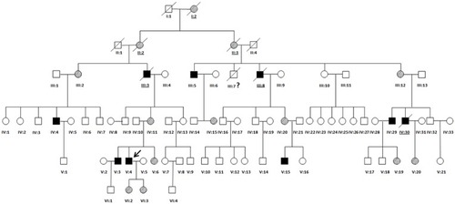 Figure 2 Family Pedigree. All individuals in the pedigree are identified by their Roman numerals below the symbol. Arabic numerals denote each individual in a generation. Squares represent males, and circles represent females. The proband (V-4) is designated with an arrow. Open symbols are unaffected individuals, filled symbols are hemizygous individuals, symbols with backslashes are heterozygous individuals, and symbols with diagonal lines indicate deceased subjects. Underlined numerals are obligate carriers who did not undergo molecular analysis. Numeral with a question mark (?) is an individual with an uncertain genetic status.