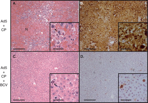 Figure 1. Brincidofovir (BCV) decreases adenovirus type 5 (Ad5)-induced lesions in the liver. Syrian hamsters were immunosuppressed using cyclophosphamide, then infected intravenously with 1.9 × 1012 virus particles/kg of Ad5. Livers of hamsters killed at day 6 were subjected to histopathological and immunohistochemistry (IHC) evaluation. Animals infected with Ad5 and not treated with BCV exhibited extensive coagulation necrosis throughout the liver (A) and widespread replication of Ad5, demonstrated by staining for the AdV fiber protein (B). Treatment of Ad5-infected hamsters with BCV resulted in a significant reduction in hepatocellular injury (C) and greatly reduced IHC staining for fiber (D). The arrows indicate intranuclear inclusion bodies. The scale bars represent 200 mm for the larger pictures and 50 mm for the insets. N, necrosis.