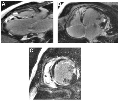Figure 2 CMR images in a patient with CS, demonstrating the widespread contrast enhancement (LGE) typical of granuloma, extending throughout the myocardium and not constrained to a coronary artery distribution.