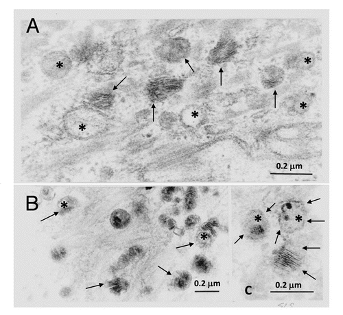 Figure 1 Abnormal LBs in the stratum granulosum of SLS skin. (A–C) Many organelles appear empty (asterisks) or display non-lamellar contents. There is variation in the content and structural appearance of cargo membranes. The limiting vesicle membranes of some LBs appear disrupted or absent (arrows). Reprinted from Rizzo et al. Arch Dermatol Res 2010; 302:443.
