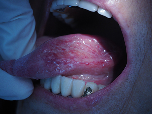 Figure 2 Clinical examination of the tongue revealing a nodular, ulcerated, infiltrating mass on the left side, extending inferiorly towards the ventral surface.