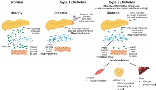 Figure 1. The process of development of DM. T1DM is characterized as a hypoinsulinemic and hyperglycemic state resulting from the autoimmune destruction of the islet beta-cells. T2DM is a hyperinsulinemic state initially to compensate insulin resistance in muscle, liver, and adipose tissues due to inflammatory responses or altered insulin receptor signaling; but over time insulin levels are reduced due to dysfunction of islet beta-cells, i.e. hypoinsulinemia. Hyperglycemic state remains in T2DM.