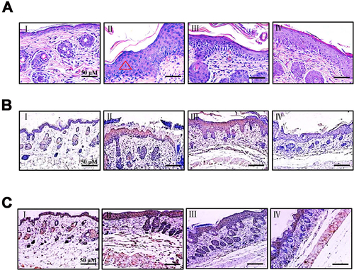 Figure 3 The histopathological changes of the lesion skin in psoriasis mice, and effect of CUR on the protein expression of TNF-α and IL-6 in lesion skin of the psoriasis mice. (A) Results of HE staining between groups. (B) IHC staining of TNF-α. (C) IHC staining of IL-6. I, Control; II, Model; III, CUR 50 mg/kg; IV, CUR 100 mg/kg. Scale bar, 50μm. The selected pictures were typical in each group, N=4 per group.