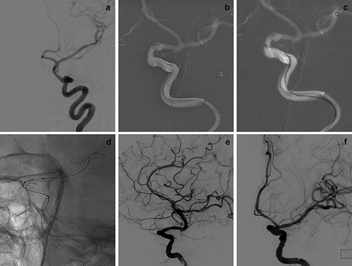 Figure 3 A 56-year-old woman with a left traumatic pseudoaneurysm. (a) The preprocedural DSA image showed that a pseudoaneurysm was located at the C5 segment of the left ICA. (b–d) The WCS was transferred to bridge the aneurysm orifice on the basis of the roadmap and was successfully deployed. (e and f) Cerebral angiogram immediately after stent deployment showed complete occlusion of the pseudoaneurysm without an endoleak.