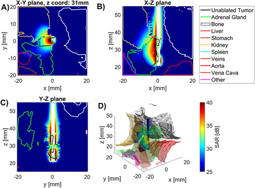 Figure 2. Specific absorption rate in tissues near applicator in (A) radial, and (B), (C) longitudinal (B), (C) slices along the applicator (white space) as well as D) 3D visualization of applicator (blue), tumor (temperature map), kidney (beige), spine (white) and other (purple) with SAR map overlaying tumor volume.