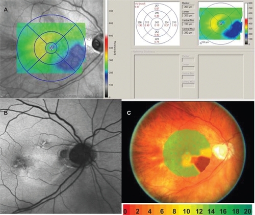 Figure 3 A) Retinal thickness mapping demonstrates thinning of the retina in the paillomacular bundle, extending inferior temporally. B) Fundus autoflourescence shows hyperfluorescence in the area of retinal thinning. C) Microperimetry (MP-1) demonstrates loss of threshold corresponding to the area of thinning. The blue dots are a fixation map of the patient while doing the test. Color codes indicate visual sensitivity in decibels.