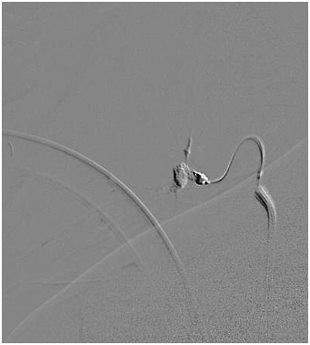 Figure 2. DSA of the left facial artery showing embolization of the pseudoaneurysm with ethylene vinyl alcohol copolymer (Onyx ®LES, Medtronic, Minneapolis, MN). Note the conformability of the Onyx cast perfectly matching the pseudoaneurysm seen in Figure 1.
