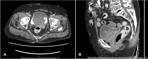 Figure 1 Axial (A) and sagittal (B) CT scans of the whole abdomen included the pelvis with IV contrast injection demonstrated a large heterogenous enhancing mass, 5.3×6.2 cm in size with internal calcification in the urinary bladder.