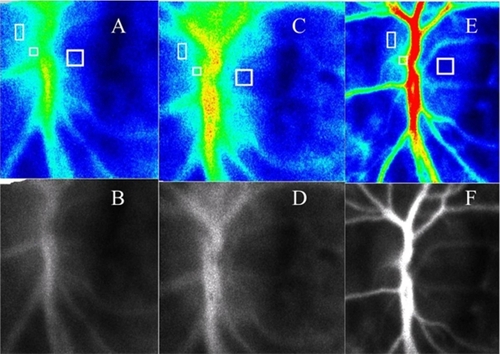 Figure 2 Optic nerve head blood flow levels by LSFG. We show examinations with LSFG from the first and second days, as well as three months later. B, D, and F are monochrome-converted images of A, C and E, respectively, which makes observing optic nerve heads and vessels easier. The square shows the blood flow (A, C, E) measurement part of CRA, both the optic nerve head of the nasal side as well as the temporal side. The blood flow rate in the CRA improved by 84.3%, on the temporal side it improved by 32% and that of the nasal side showed a 3.9% improvement. Three months later, the CRA blood flow rate was shown to have improved by 253%, although that of the temporal side and nasal side of ONH decreased by 10% and 15%, respectively.