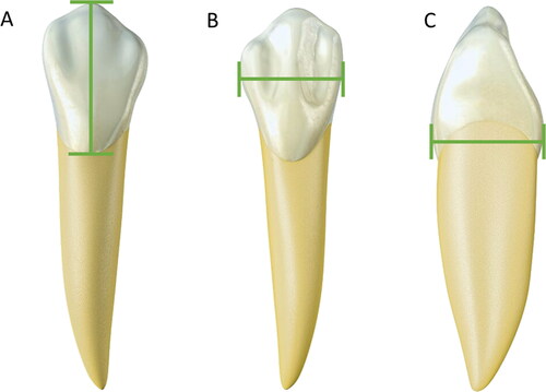 Figure 3. Metric analyses with statistical significance in sex estimation — canine teeth. (A) Cervical–incisal distance. (B) Mesiodistal width. (C) Vestibular–lingual distance. Males exhibit larger measures than females due to more voluminous teeth.
