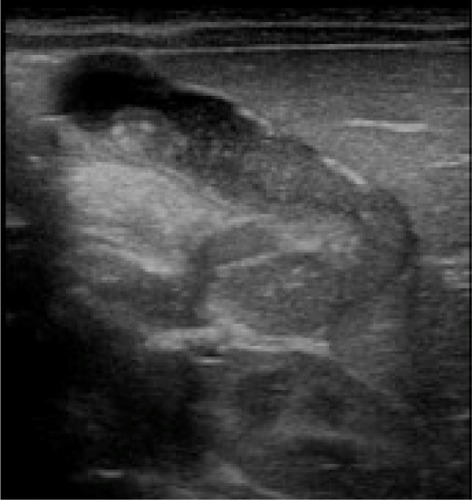 Figure 3 The gallbladder after 2 weeks of treatment – partial and gradual improvement.