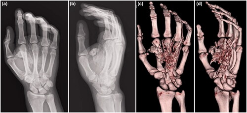 Figure 2. X-ray (a, b) and computed tomography (c, d) images show that the paint spread extensively along the flexor tendons of the palm.