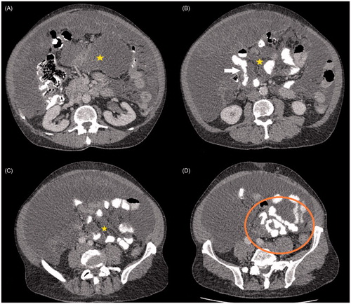 Figure 4. CT axial sections of same patient showing extensive small bowel and mesenteric involvement. There is low density mucin in the mesentery (*). Small bowel involvement is seen as distortion and narrowing of bowel lumen (arrow) and scalloping of bowel lumen seen as changing calibre of bowel (circle).