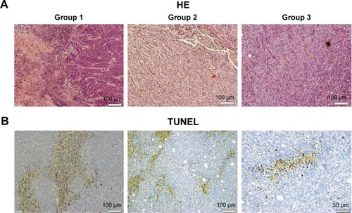 Figure 7 HE and TUNEL staining micrograph of tumors from sacrificed mice.Notes: (A) HE micrograph of tumor slices from three different groups. Necrosis tissues and inflammatory cells were detected in group 1 but hardly seen in group 2 or 3. The scale bar represents 100 µm. (B) TUNEL micrograph of tumor slice from group 1. Multiple brown-stained cancer cells (TUNEL-positive cells) were observed in pancreatic tumor cells treated with irradiating by fiber directly inserting into tumor, indicating apoptosis. Scale bar: left 100 µm; middle 100 µm; right 50 µm.Abbreviations: HE, hematoxylin and eosin; PDT, photodynamic therapy; TUNEL, terminal deoxynucleotidyl transferase (TdT)-mediated deoxyuridine triphosphate (dUTP)-biotin nick end labeling.