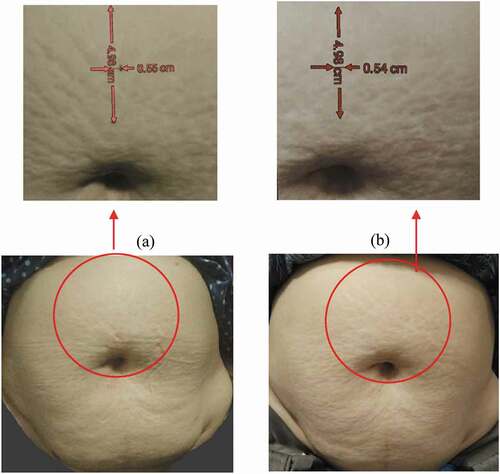 Figure 1. Clinical SA lesions in study subjects in 0.1% tretinoin single-therapy, pre-therapy (A) and post-therapy (B)