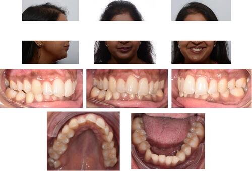 Figure 11 Clinical case 2: initial pictures of face and intraoral images.