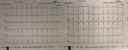 Figure 1 Electrocardiography of the patient on admission.