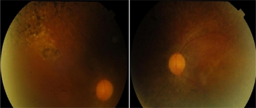 Figure 2 Fundus photograph right and left eye; showing bone spicule pigmentation, pale disc, and attenued retinal vessels.