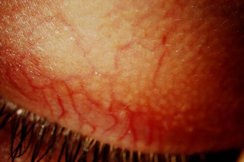 Figure 3 The same blood vessel tortuosities may be seen on the external upper lid.