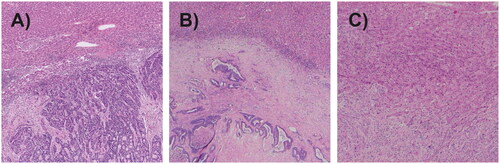 Figure 2. Tumor growth patterns. (A) Pushing growth pattern. (B) Desmoplastic growth pattern. (C) Replacement growth pattern.