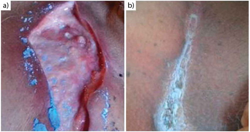Figure 2. Chronological evolution of the ulcer on upper pectoral region. Initial appearance (a), ulcer at 30 days (b).
