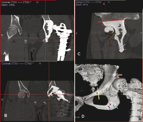 Figure 3. Preoperative display of the surgical planning for Patient 1 on the navigation monitor. Coronal (A) and sagittal (C) images showed image fusion of CT data sets with virtual osteotomies (representing the pelvic model in Figure 2A) and the original CT data sets. The fusion images helped to locate exactly the planned planes of the osteotomies, which were then marked with virtual screws (C). Coronal images (B) illustrated image fusion of CT data sets with virtual realignment (representing the pelvic model in Figure 2B) and the original CT data sets. The planes of the periacetabular osteotomies were marked with virtual screws on the reconstructed 3D pelvic model (D). For the actual operation, following surgical exposure of the acetabulum and insertion of a tracker into the iliac crest, image-to-patient registration was performed on the original CT datasets. The osteotomy planes were defined by locating the positions of the virtual screws under navigational guidance. The pelvic bone was then osteotomized with an oscillating saw and osteotomes. The acetabular bone segment was realigned to open a bone defect above the acetabulum, and an iliac crest bone graft (Figure 2C) was inserted into this defect. On toggling the fusion image to CT datasets with virtual realignment, the surface of the mobilized acetabular bone segment was traced by a navigation pointer. The position of the acetabulum was adjusted and assessed to be optimal if it matched with its corresponding position on the CT datasets with virtual realignment. The acetabular segment was then temporarily secured to the iliac bone with K-wires. The bone graft was fixed with two 6.5-mm cannulated titanium screws under navigational guidance (Figure 2D) which helped to avoid penetration into the hip joint.