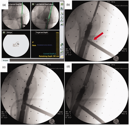 Figure 3. Navigated technique for minimally invasive removal of buried nails. (a) Screenshot of the navigation system display. Based on two orthogonal 2D fluoroscopic images (antero-posterior and axial) a navigated guide-wire can be placed precisely in the hole of the end-cap. (b) Intraoperative fluoroscopic control image showing the precise guide-wire placement via a navigated drill sleeve. The dynamic reference base for the navigation procedure was placed in an existing drill hole after removal the most proximal locking screw (red arrow). (c) Preparation of the osseous tunnel to the nail with a cannulated driller. (d) Removal of bone overgrowth around the end cap using a cannulated crown drill.