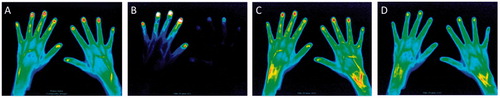 Figure 3. Images of FOI in a healthy volunteer. A composite image (A) and representative images of Phase-1 (B), Phase-2 (C) and Phase-3 (D) in a healthy volunteer. No enhancement was seen in the composite image and all three phases.