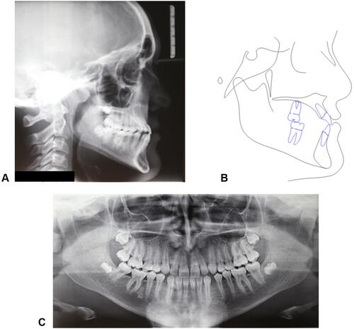 Figure 2 Initial records of the patient. (A) Lateral headfilm. (B) Cephalometric tracing. (C) Panoramic radiograph.