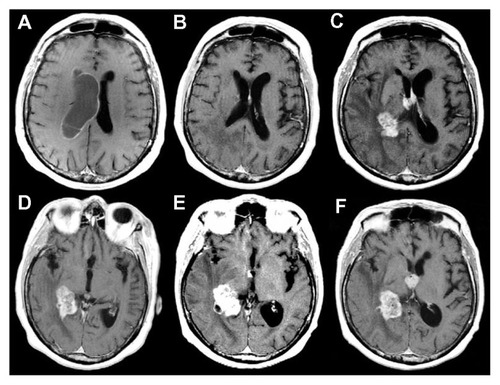 Figure 5 Preoperative, contrast-enhanced, axial, T1-weighted magnetic resonance images.*The left ventricle looked normal.