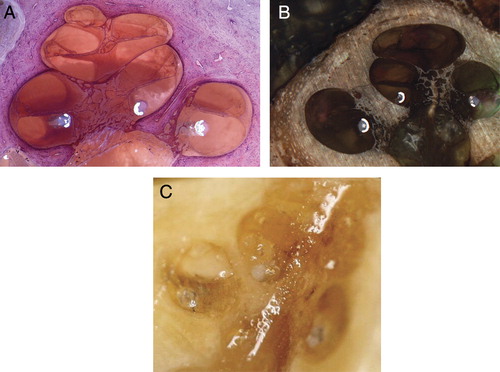 Figure 8. MRA (version 6) mid-modiolar section showing excellent modiolar placement and no evidence of trauma. Images courtesy of (A) CRC Hear, Melbourne, Australia; (B) Medizinische Hochschule Hannover; and (C) New York University.