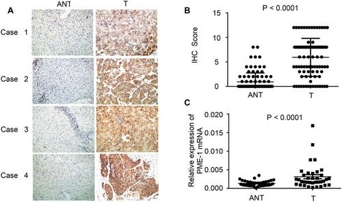 Figure 2 Comparison of PME-1 expression between HCC tissues and paired adjacent noncancerous liver tissue. (A) The representative expression patterns of PME-1 in four cases. Scale bars = 50μm. (B) PME-1 protein expression in HCC was significantly higher than that in normal liver tissues (P < 0.0001). (C) PME-1 mRNA expression level was relatively higher in HCC compared with that in normal liver tissues (P < 0.0001). Data were analyzed with 2-related samples Wilcoxon test.Abbreviations: ANT, adjacent noncancerous tissue; T, cancer tissues.