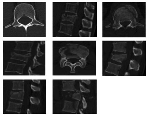 Figure 1. Sample spine fracture CT images.