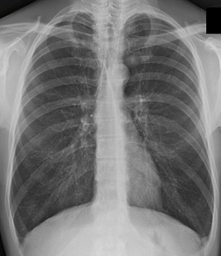 Figure 3 Chest x-ray of a COPD patient showing pulmonary hyperinflation characterized by parenchymal hyperdiaphania and flattening of the diaphragm.